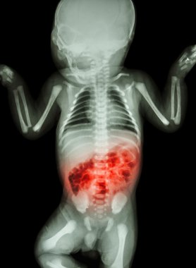 Enterit (X-ray hasta bebek ve bağırsak iltihabı)