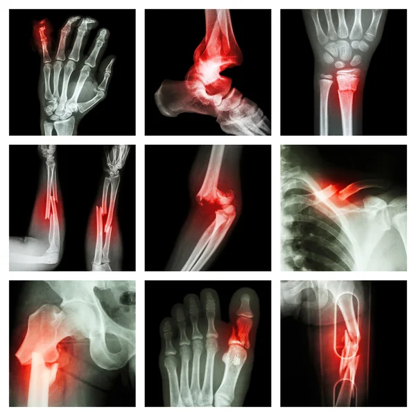Collection of bone fracture — Stock Photo, Image