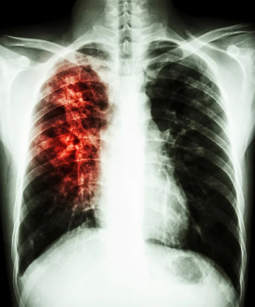 Gruźlica płuc — Zdjęcie stockowe