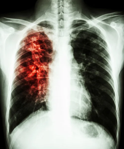 Pulmonalis tuberkulózis — Stock Fotó