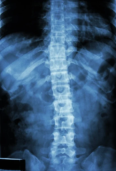 Normal human's thoracic-lumbar spine — Stock Photo, Image