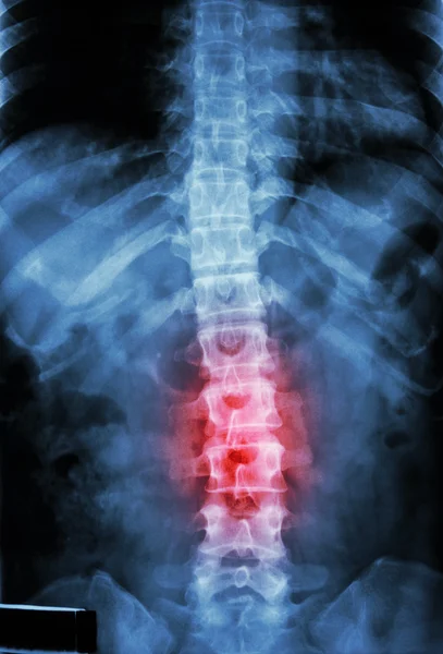 Плівковий рентгенівський Т-Л хребет (грудний-Ламбарний хребет) показує: грудний-світловий хребет людини та запалення на поперековому відділі хребта — стокове фото