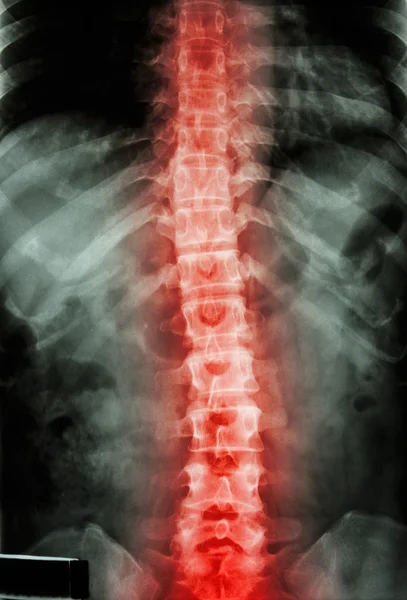 Film x-ray T-L spine(Thoracic-Lumbar spine) show : human's thoracic-lumbar spine and inflammation at spine — Stock Photo, Image