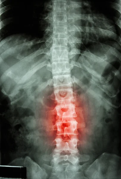 Film x-ray T-L spine(Thoracic-Lumbar spine) show : human's thoracic-lumbar spine and inflammation at lumbar spine — Stock Photo, Image