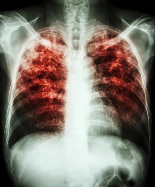 Pulmonary tuberculosis — Stock Photo, Image