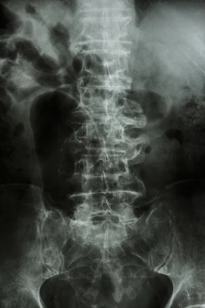 "Spondilosi "Radiografia della pellicola: colonna vertebrale lombare con sperone & collasso a — Foto Stock