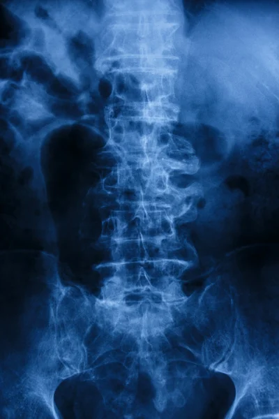 "脊椎症"フィルムX線:拍車および崩壊の腰椎 — ストック写真