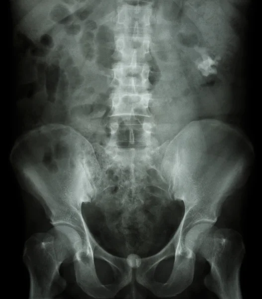 Cálculo renal izquierdo (área opaca en la parte superior derecha de la imagen) y bladd — Foto de Stock