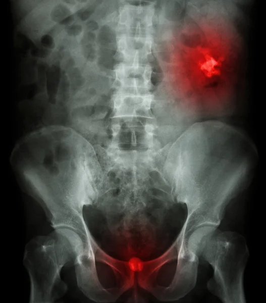 左の腎臓結石 (画像の右上に不透明な領域) と bladd — ストック写真