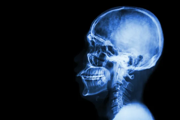 X-ray asian skull and blank area at left side — Stock Photo, Image