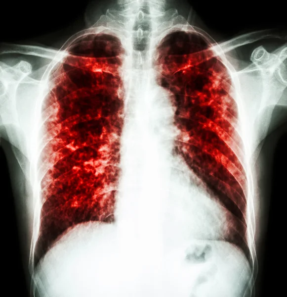 Tuberculosis pulmonar — Foto de Stock