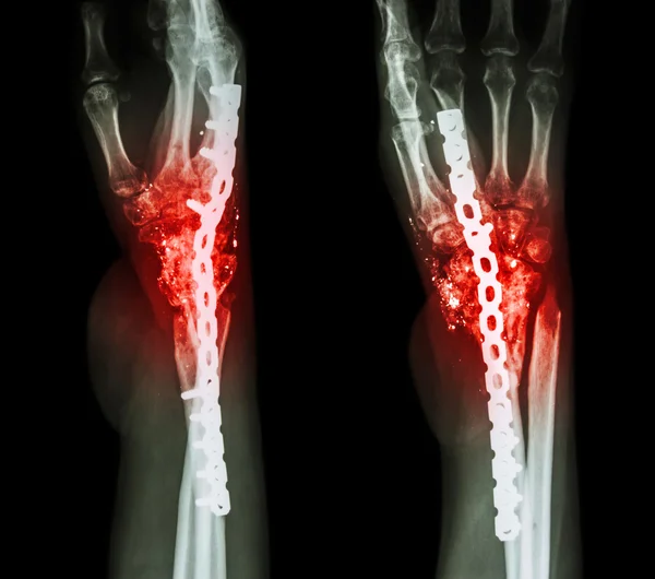 Fracture wrist and chronic infection. It was operated and intern — Stock Photo, Image