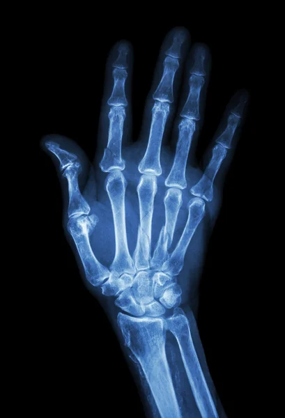 Multiple fracture at index,little finger,metacarpal bone — Stock Photo, Image