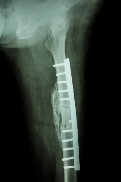 Fracture shaft of femur. It was operated and internal fixation b — Stock Photo, Image