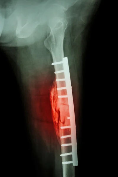 Fracture shaft of femur. It was operated and internal fixation b — Stock Photo, Image