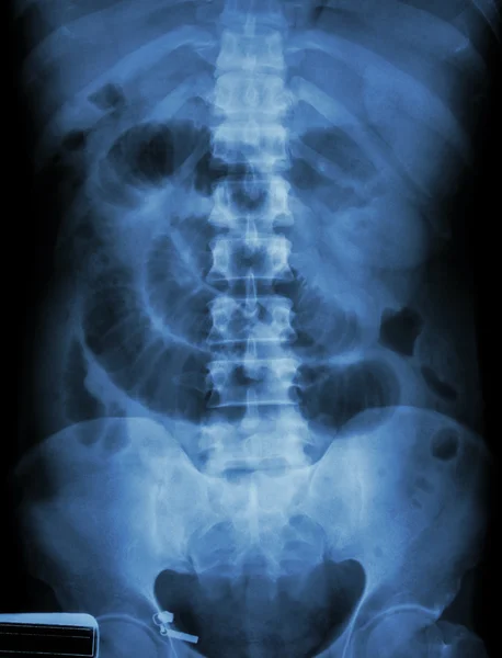 "Small intestine obstruction"  Film X-ray abdomen supine : Show — Stock Photo, Image