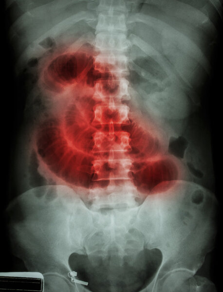 "Small intestine obstruction"  Film X-ray abdomen supine : Show 