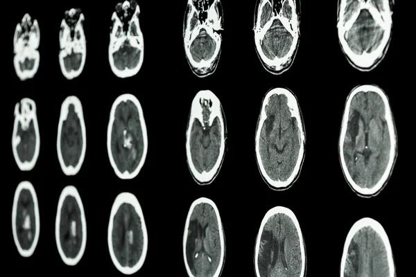 TAC a pellicola del cervello mostrano ictus ischemico e ictus emorragico — Foto Stock