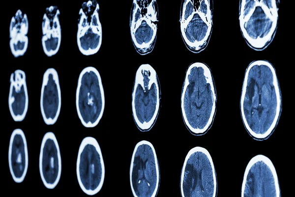 虚血性脳卒中と出血性 strok 製の映画脳の Ct スキャンを見る — ストック写真