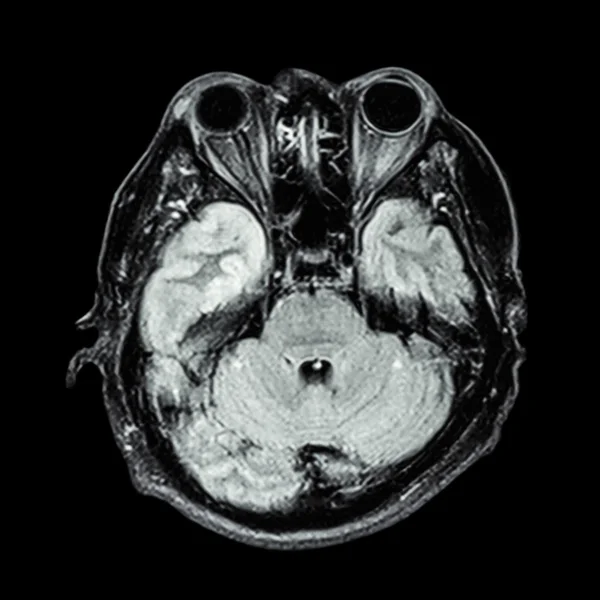 RM cerebral: mostrar la parte inferior del cerebro (cerebelo, lóbulo temporal de — Foto de Stock