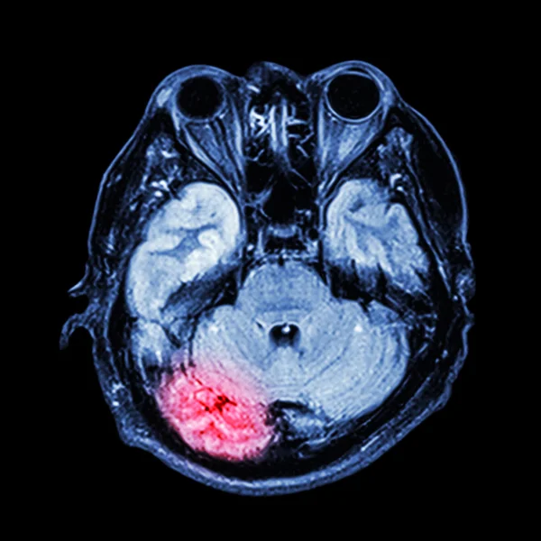 MRI mozku: Zobrazit spodní část mozku (mozeček, spánkový lalok — Stock fotografie