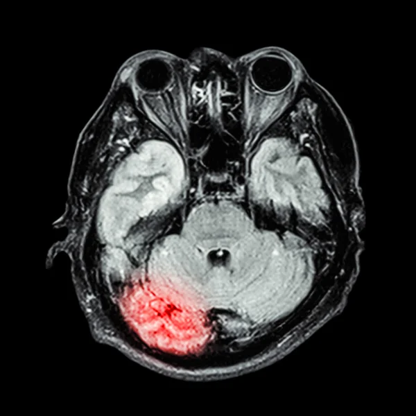 磁共振脑: 显示脑 (小脑、 颞叶的下部 — 图库照片
