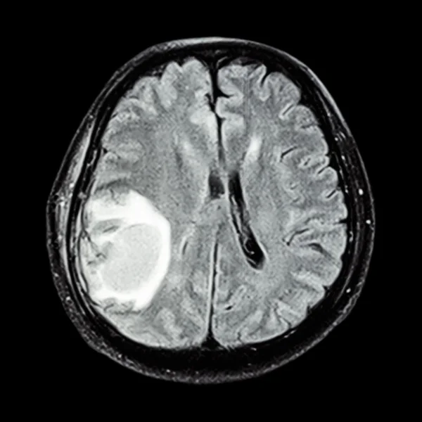 МРТ-мозок: показати пухлину головного мозку на правій тім'яній частці мозку — стокове фото