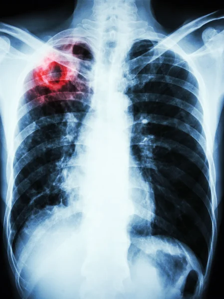 Infeksi Mycobacterium tuberculosis (Pulmonary Tuberculosis ) — Stok Foto