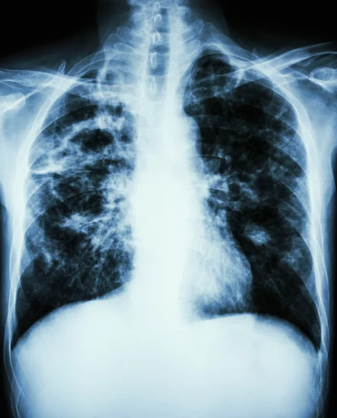 Infecção por Mycobacterium tuberculosis (Tuberculose pulmonar ) — Fotografia de Stock