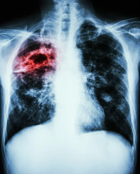 Mycobacterium tuberculosis infection (Pulmonary Tuberculosis) — Stock Photo, Image