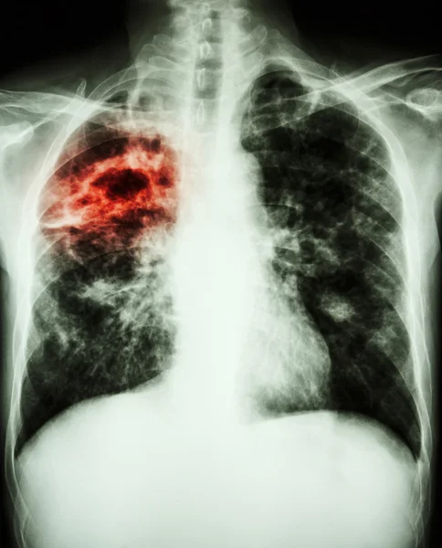 Mycobacterium tuberculosis fertőzés (pulmonalis tuberkulózis) — Stock Fotó