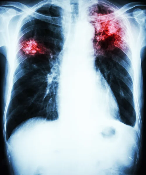 Tuberculosis pulmonar —  Fotos de Stock