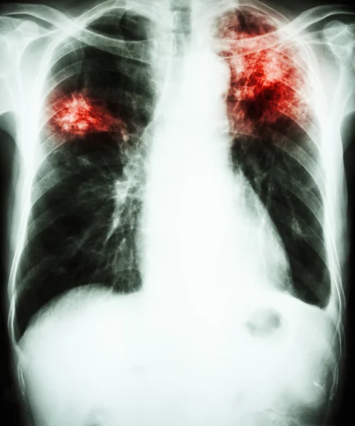 Tuberculose pulmonar — Fotografia de Stock