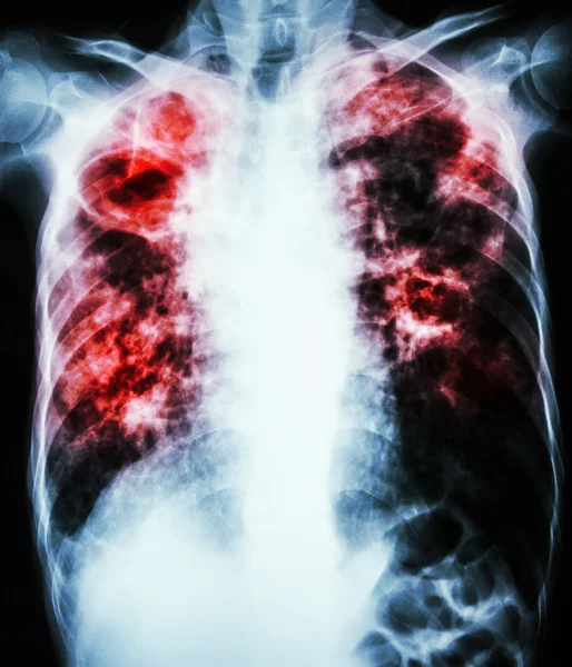 Mycobacterium tuberculosis infection (tuberculose pulmonaire ) — Photo