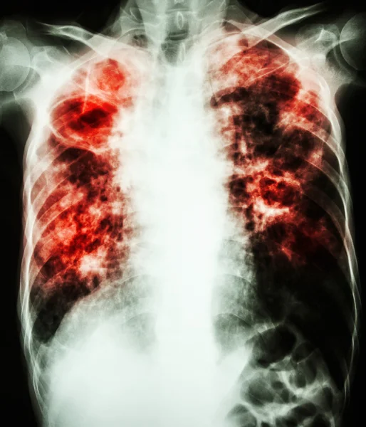 Mycobacterium tuberculosis infection (Pulmonary Tuberculosis) — Stock Photo, Image