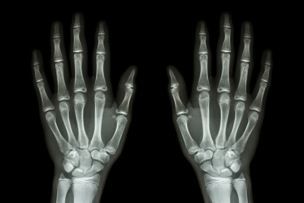 X-ray normal human hands (front) on black background