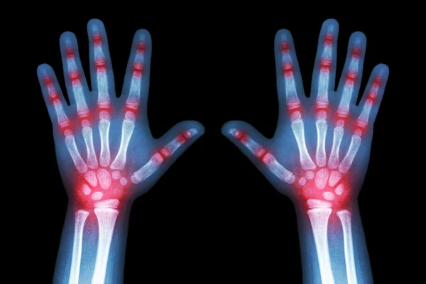 Rheumatoid arthritis ( X-ray both child hands and multiple joint arthritis ) — Stock Photo, Image