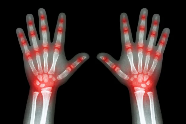 Reumatoidalne zapalenie stawów (X-ray zarówno rąk dziecka i wielu stawów ) — Zdjęcie stockowe