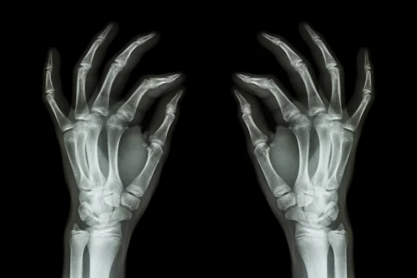 X-ray normal human hands (front) on black background — Stock Photo, Image