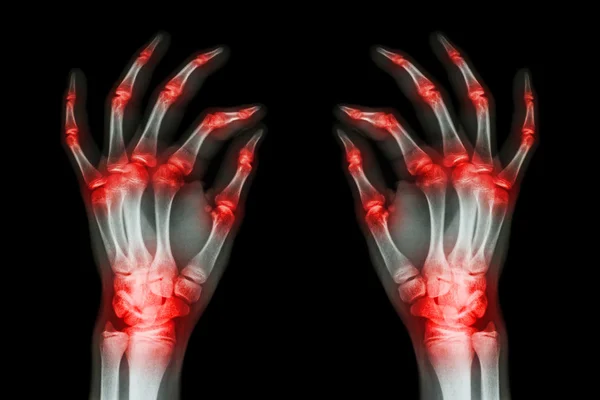 Multiple joint arthritis both adult hands ( Gout , Rheumatoid ) on black background — Stock Photo, Image