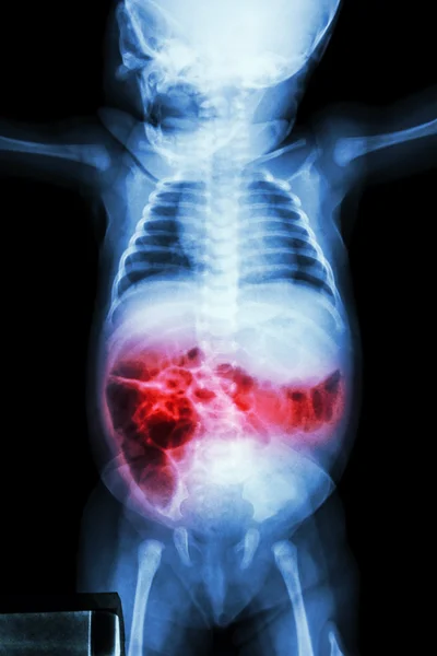 Enteritis (X-ray of sick infant and inflammation of intestine) — Stock Photo, Image