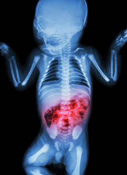 Enterite (raio-X do lactente doente e inflamação do intestino ) — Fotografia de Stock