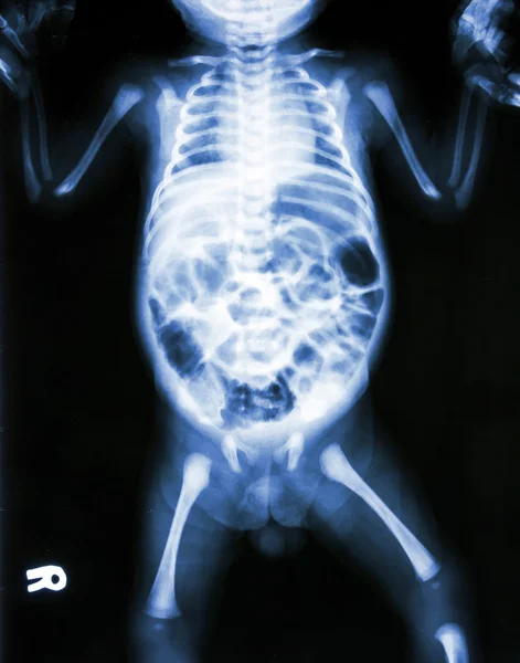 Enterit (X-ray hasta bebek ve bağırsak iltihabı) — Stok fotoğraf