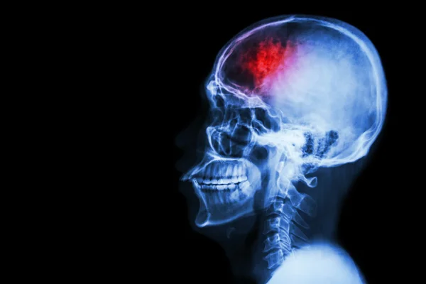 "脳卒中」(脳血管事故)。左側にストロークと空白の領域を持つフィルムX線頭蓋骨の横 — ストック写真