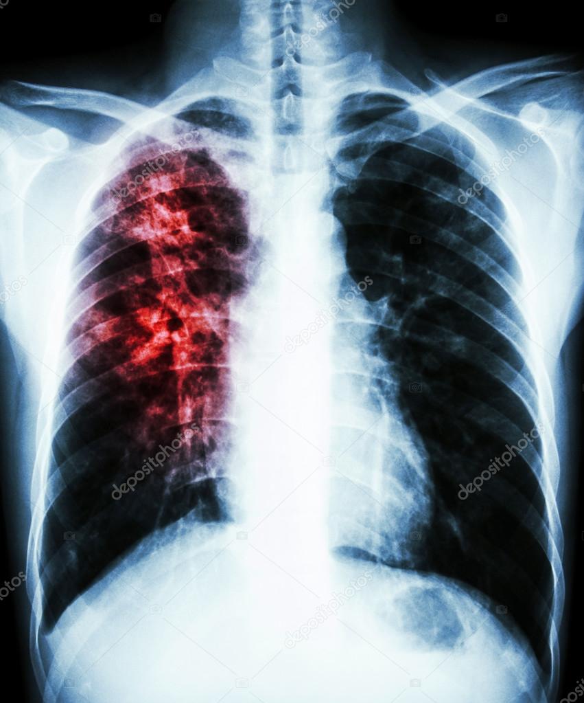 Resultado de imagen para tuberculosis pulmonar