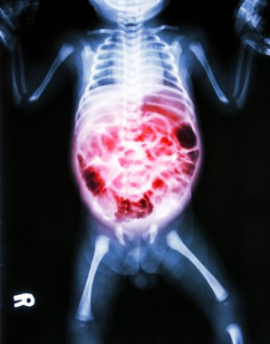 Enterit (X-ray hasta bebek ve bağırsak iltihabı)