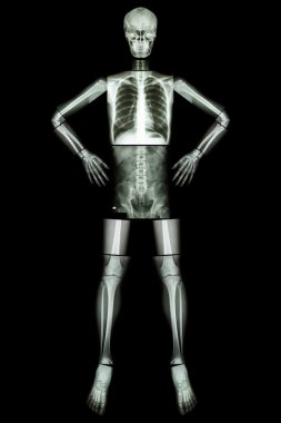 İnsan kemik standı ve akimbo (X-Ray tüm vücut : baş kafatası boyun omurga omuz kol dirsek önkol bilek el parmağı göğüs toraks kalp akciğer karın geri vertebra pelvis kalça uyluk diz ayak bileği ayak )