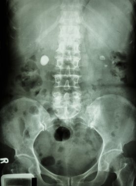 Bilateral renal taş