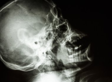 normal insan kafatası