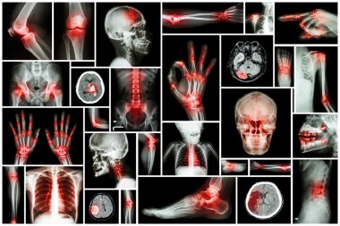 İnsan birden çok bölümü birden çok hastalık ile x-ışını (inme, artrit, gut hastalığı, romatizma, beyin tümörü, osteoartrit, vb)